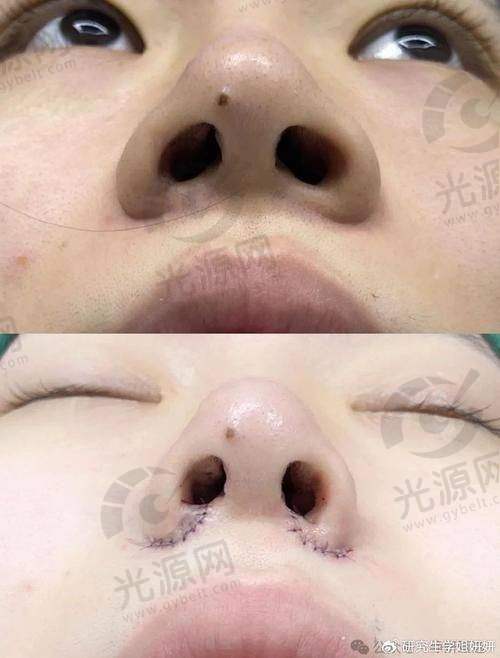 外切鼻翼手术后结果的长期观察