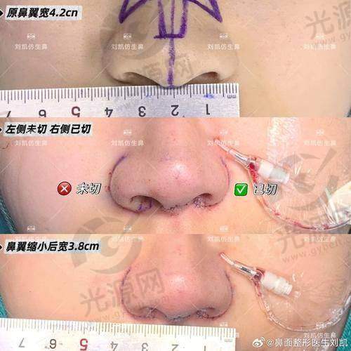 外切鼻翼手术后护理不当的后果