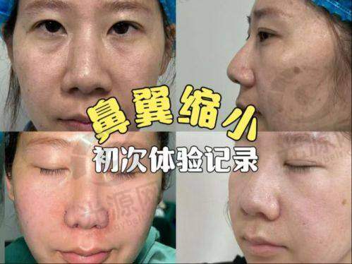 外切鼻翼胀大与个体体质差异的关联
