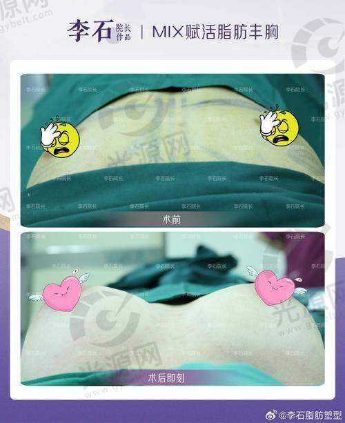 三、绍兴华美隆胸好吗，口碑与病例分享