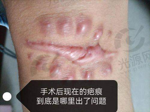 三、重庆骑士医院疤痕科口碑如何——真实实例分享