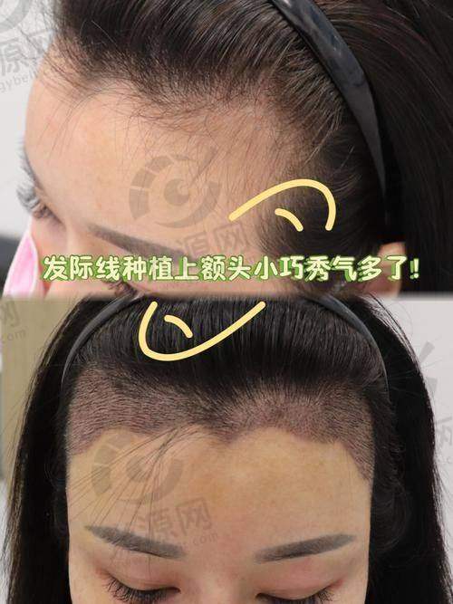 深圳植发收费情况