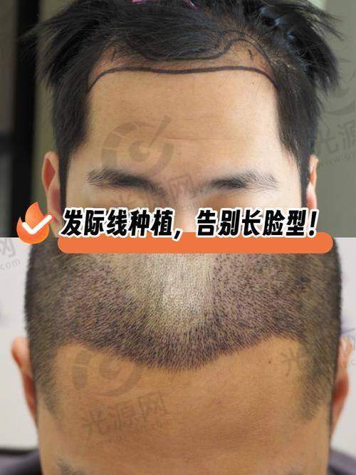 五、上海华美植发医生预约挂号攻略