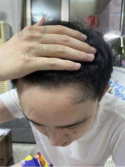 二、上海华美植发技术与医生水平