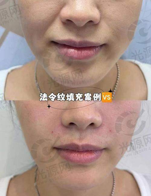 印第安纹剥离手术过程图解术后护理建议