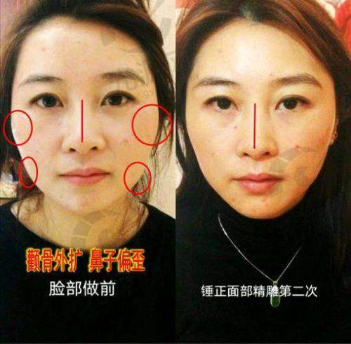 印第安纹剥离手术过程图解后的修复期