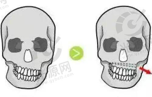 美人沟下巴可以通过玻尿酸填充去掉