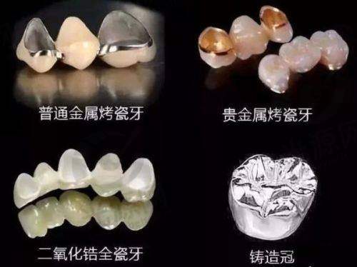 价格背后的隐患：1000元的全瓷牙和1500的全瓷牙的隐藏成本