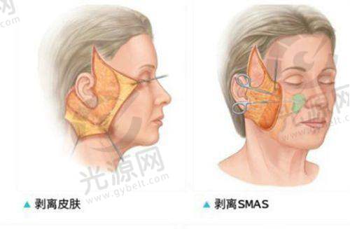 美人沟下巴如何去掉？探索玻尿酸、自体脂肪等多种有效改善方案与价格解析！
