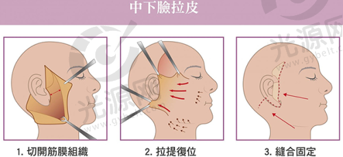 美人沟下巴可以通过激光紧肤治疗去掉
