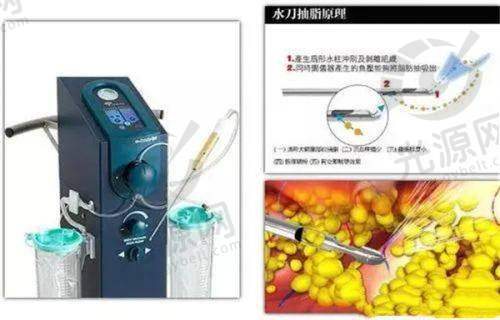 手术吸脂40斤费用组成解析