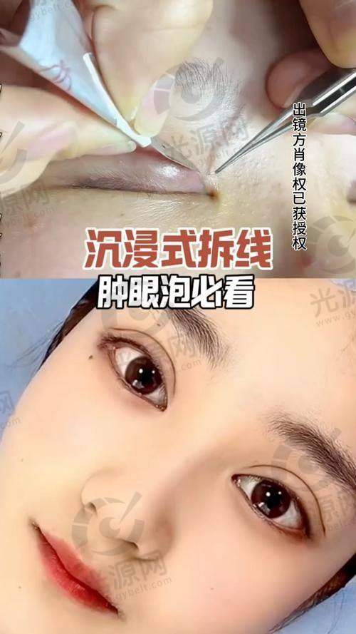 唐爱东眼修复实例分享