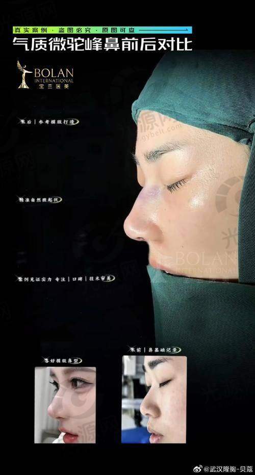 舒铂超肋鼻的安心性分析