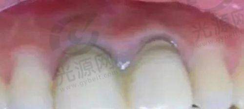 材料方面的差异：1000元的全瓷牙和1500的全瓷牙选择不同的材质