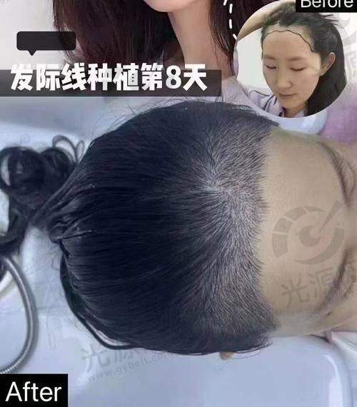 济南碧莲盛植发医院怎么样？