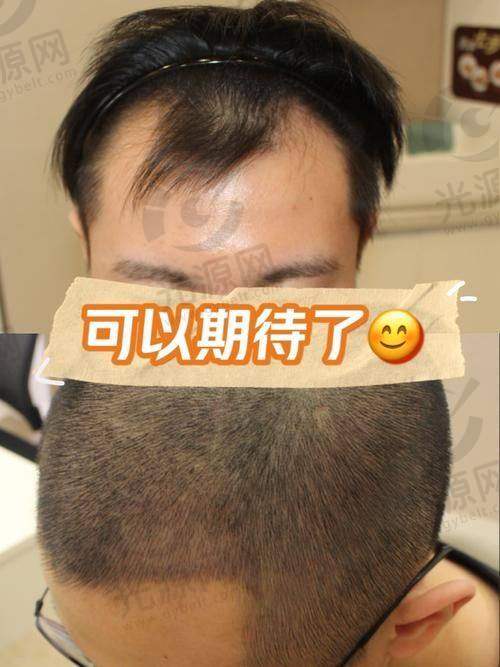 2. 济南碧莲盛BHT立体加密微针植发