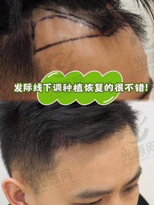 4. 济南碧莲盛不剃发植发技术