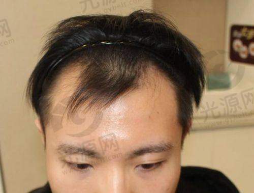 3. 济南碧莲盛AFHT美学培固植发