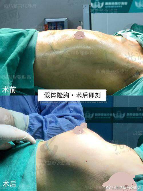 推荐的泰国精尖隆胸医院