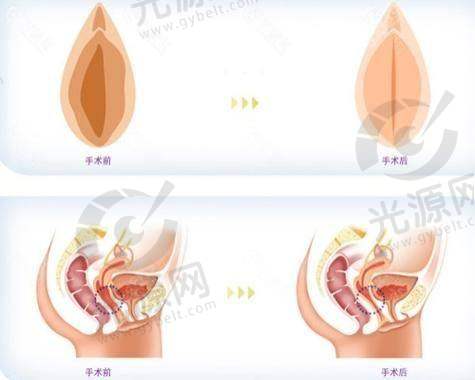 私处美白手术多少钱：影响价格的因素
