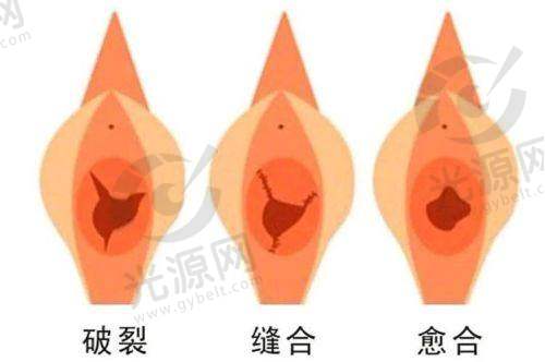 3D生物束带紧缩术需要插尿管吗？3D生物束带紧缩术效果与收费揭秘，术后多久可以同房？潜在后遗症详解！