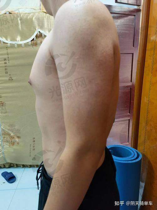男性入珠手术实图：术后的护理与修复