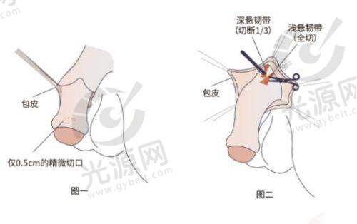 生物补片增粗手术价格解析
