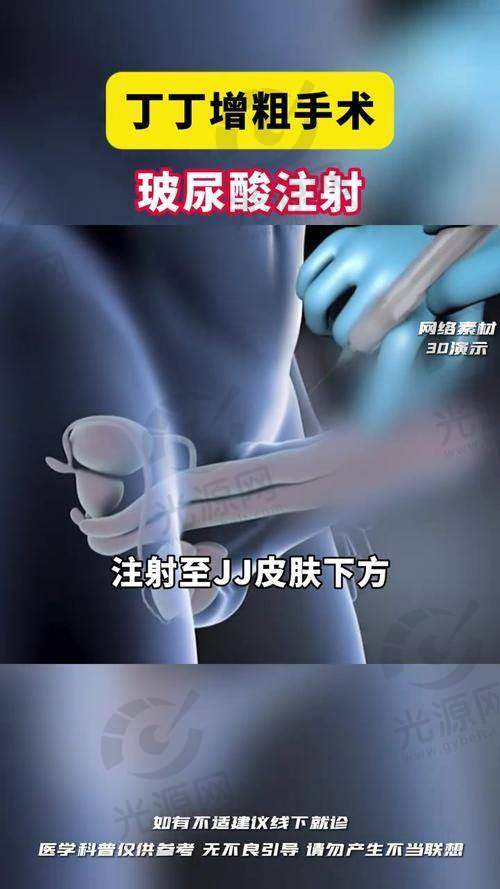 阴茎增粗手术多少钱
