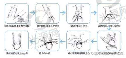 割了包皮多少费用与手术方式的选择