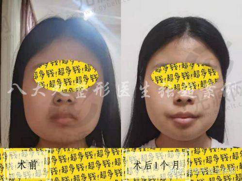 高周波去咬肌费用概述