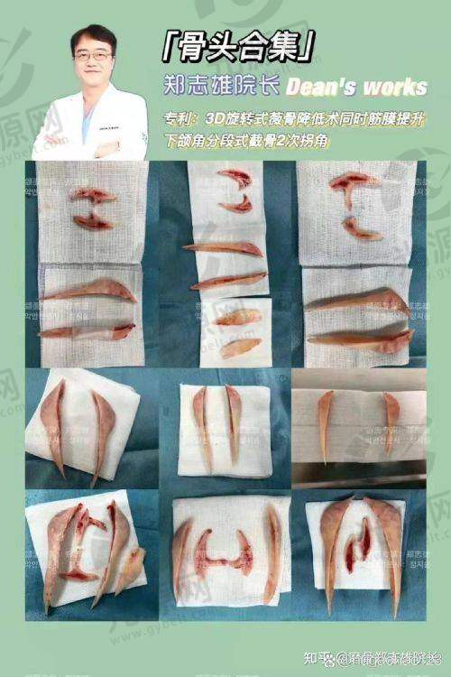 高周波去咬肌成效持久，但费用相对较高