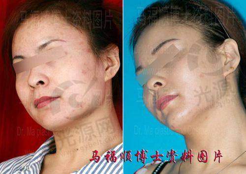 高周波去咬肌的适用人群与反馈