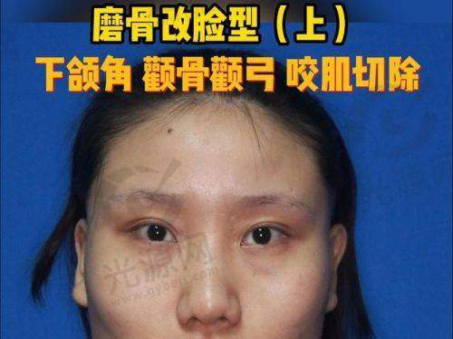 高周波去咬肌与传统方式的对比