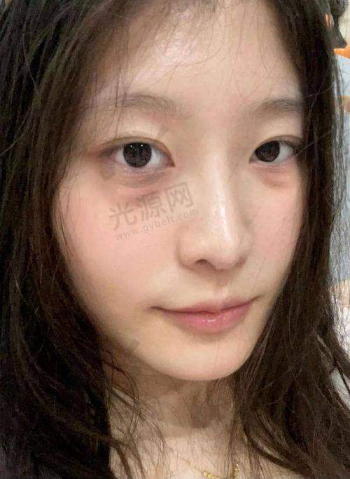 二、德州眼袋和泪沟痕整形医院项目收费情况