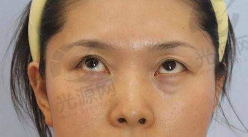 外切眼袋一个月眼角底像鼓了的医美修复