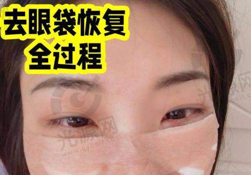 外切眼袋一个月眼角底像鼓了的注意事项