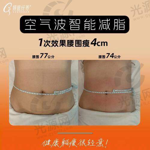 医生：大腿52厘米抽脂能瘦多少具体情况