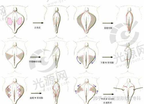 阴蒂整形手术的费用揭秘