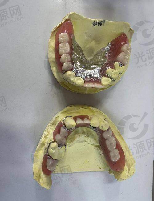 不同类型的吸附性义齿