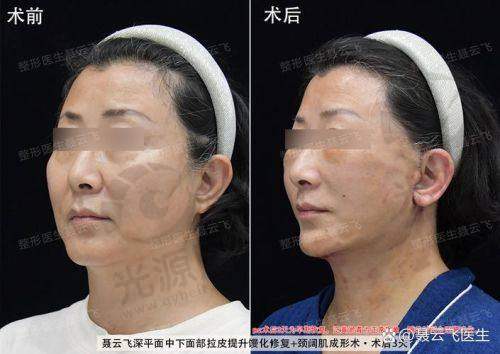 脸部拉皮半年了，脸还是麻木，如何促进修复？