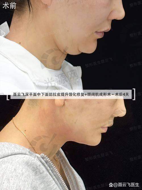 脸部拉皮半年了，脸还是麻木，是否需要复查？