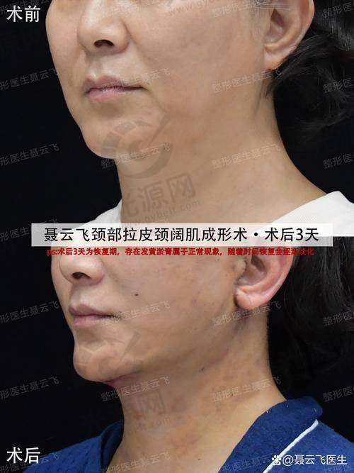 脸部拉皮半年了，脸还是麻木，除了神经损伤还有什么其他可能？