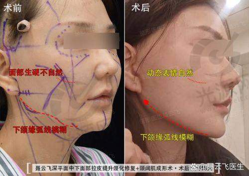 脸部拉皮半年了脸还是麻木，是什么原因造成的？