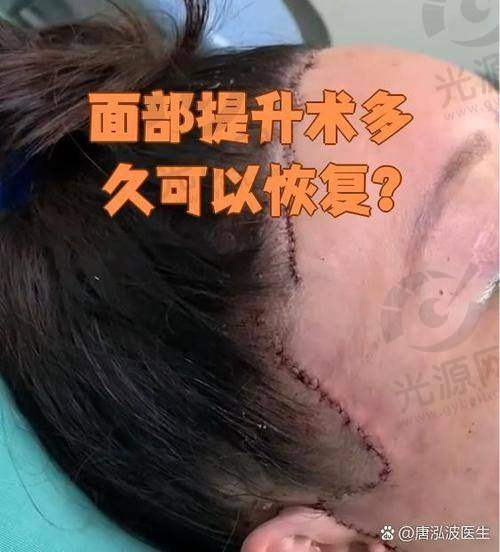 脸部拉皮半年了脸还是麻木，修复的过程是怎样的？