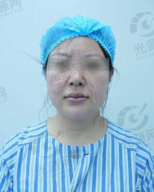 个体差异导致面部吸脂成效显现时间不同