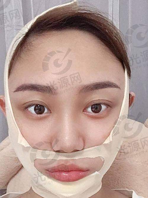 术后护理不当影响面部吸脂成效