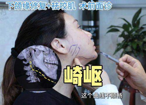 下颌角截骨后脸还是特别方的原因之四：对手术方案认知不足