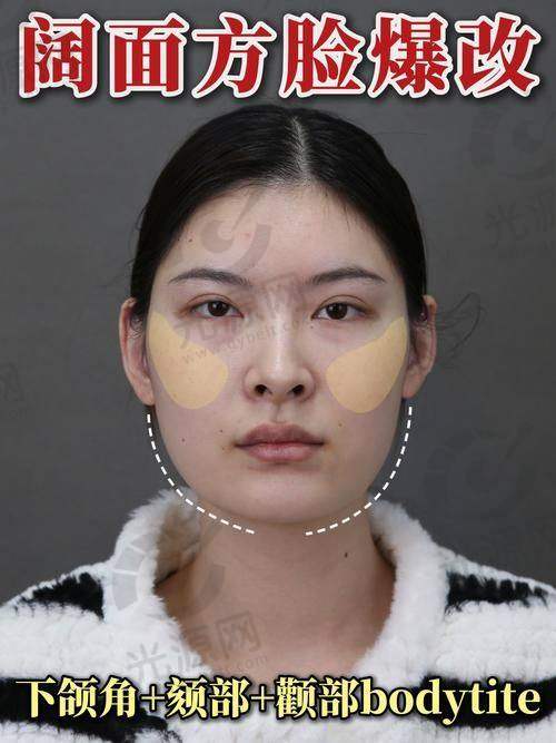下颌角截骨后脸还是特别方的原因之三：个体基础条件限制