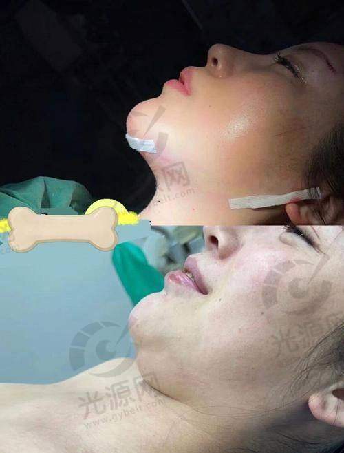 下颌角截骨后脸还是特别方的原因之六：下颌角增生影响