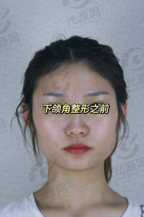下颌角截骨后脸还是特别方的原因之五：术后护理不当